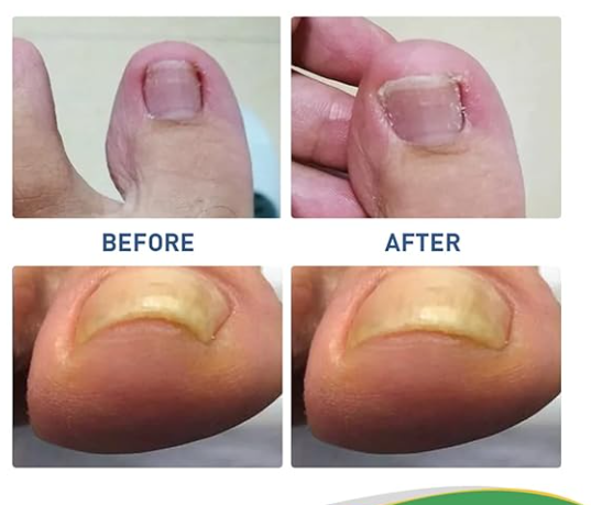 PARCHES PARA UÑAS ENCARNADAS DEL PIE